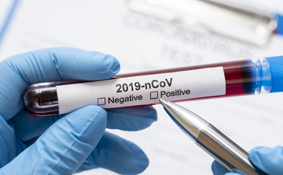 80% тестів на коронавірус в Україні безкоштовні? 