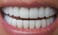 Найшкідливіші звички, які призводять до псування зубів