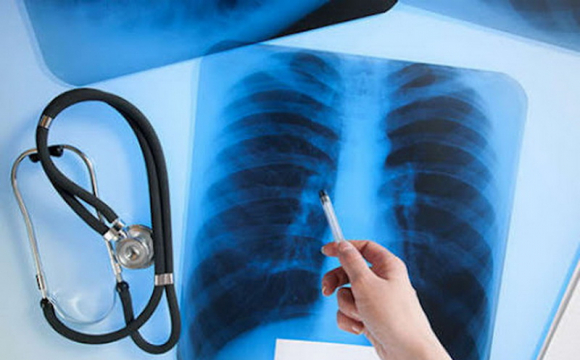 В Україні зросте смертність від туберкульозу: повідомили причину