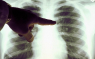 Коронавірус та туберкульоз: як не сплутати хвороби