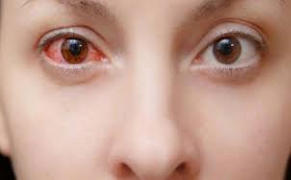 Запалення очей може бути симптомом COVID-19: подробиці