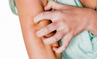 Хвороба вражає одну із 40-50 тисяч вагітних: у жінки виявили алергію на власну шкіру