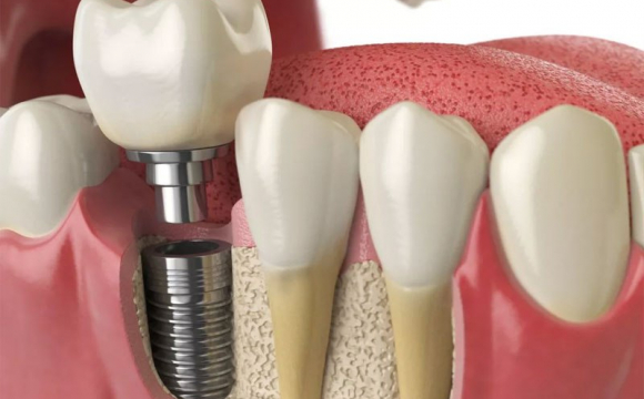 Для чого потрібна імплантація зубів*